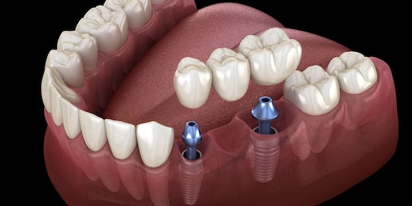 Dental Implants